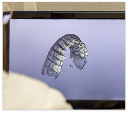 Digital model of teeth on computer screen