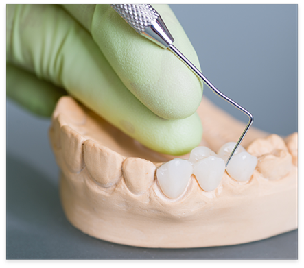 Model of the mouth with a dental bridge replacing three missing teeth