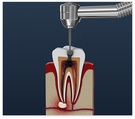 Illustrated dental instrument treating inside of a tooth during root canal treatment