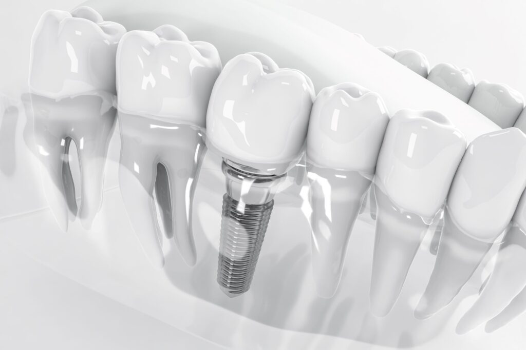 Grayscale rendering of dental implant between teeth in a transparent lower jaw with white background